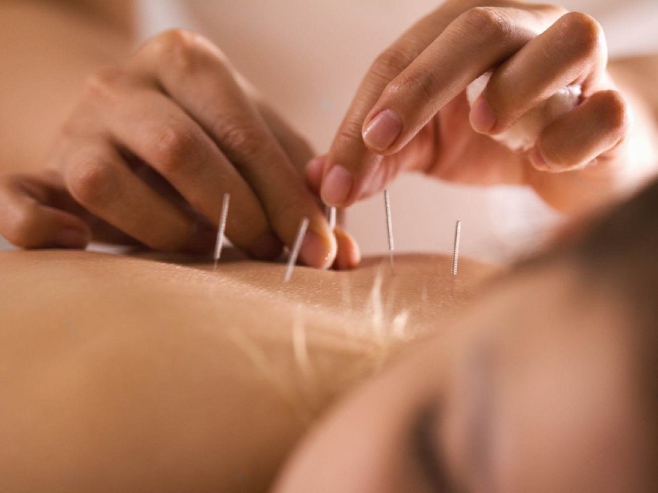 Acupuntura